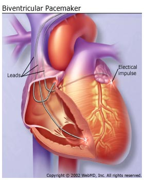 BiV pacemaker