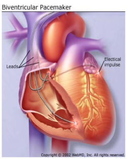 BiV pacemaker